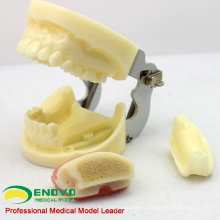IMPLANT06(12617) Implant Practice Jaw Model with Lower Jaw for Flap and Drilling Practice